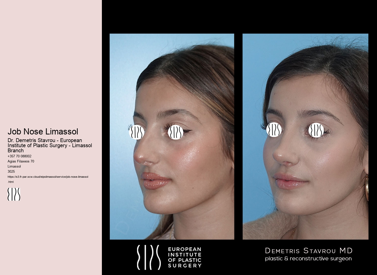 Job Nose Limassol