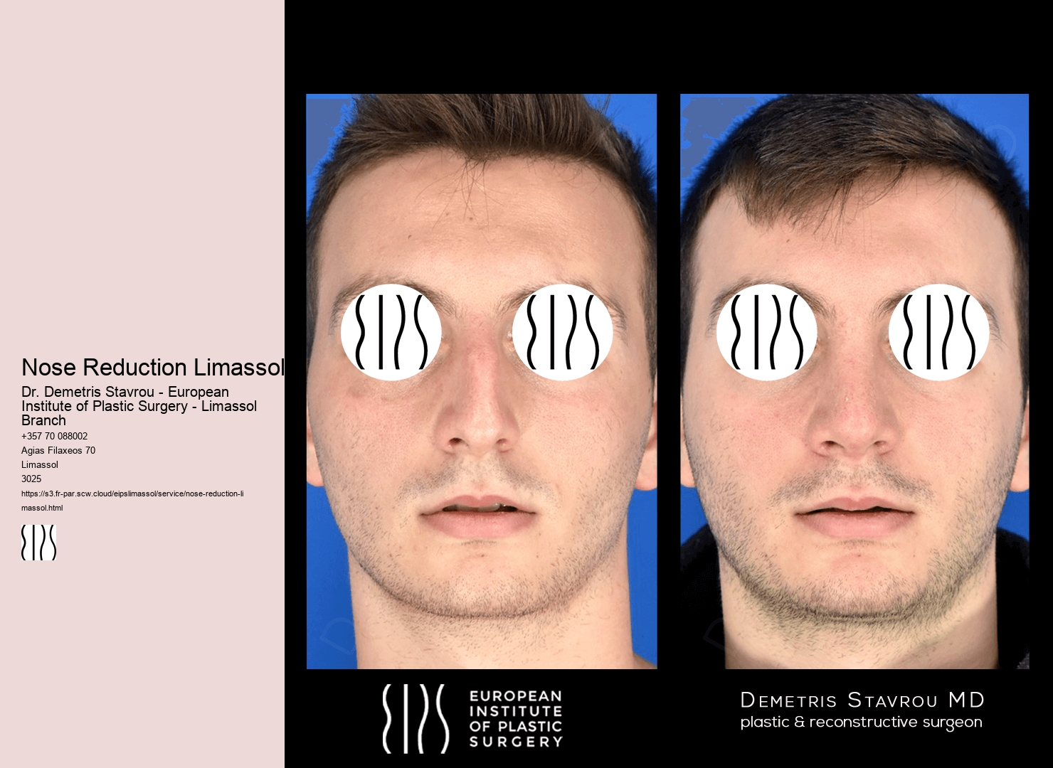 Nose Reduction Limassol
