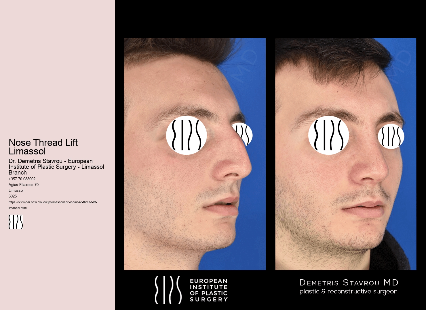 Nose Thread Lift Limassol