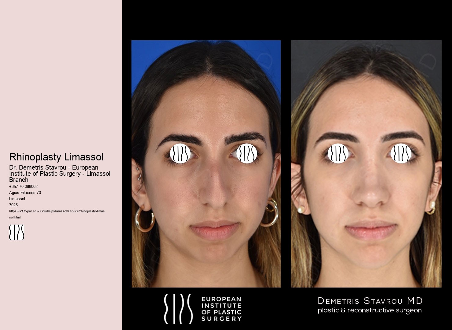 Rhinoplasty Limassol