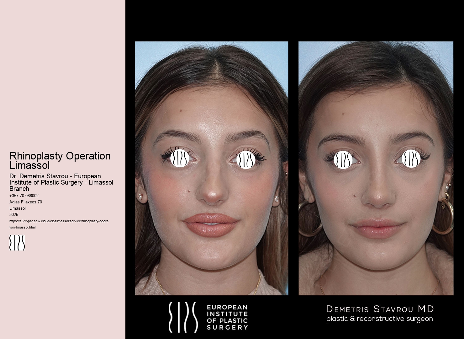 Rhinoplasty Operation Limassol