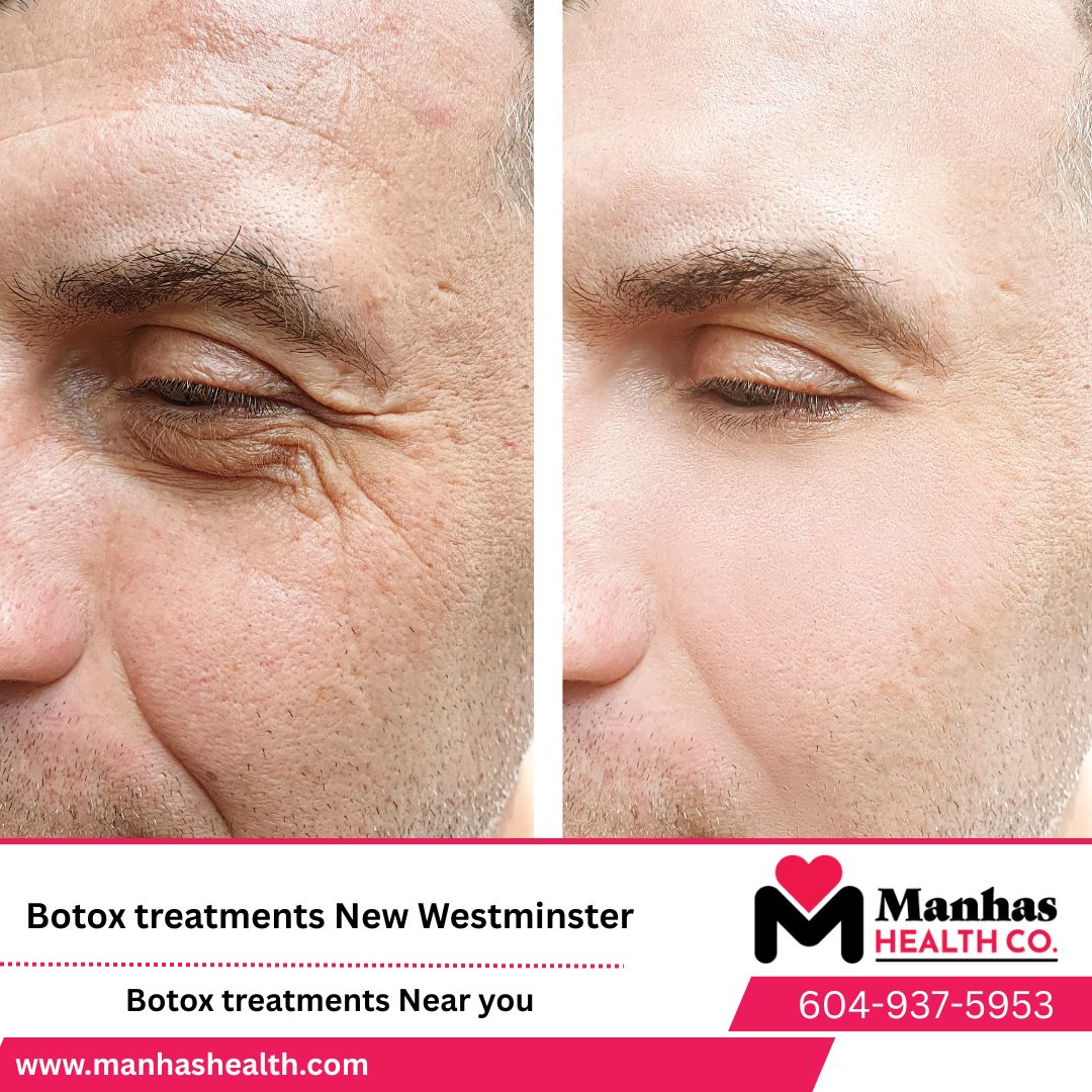 Botox and Filler Clinic difference in Coquitlam