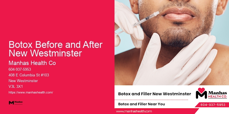 Premier Botox and Dermal Fillers Botox Before and After New Westminster