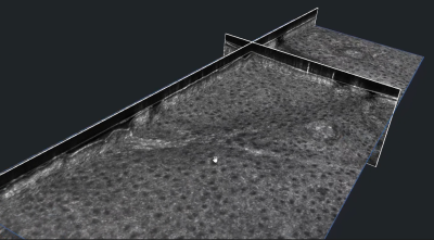 Images 3D de peau humaine acquises par tomographie de cohérence...