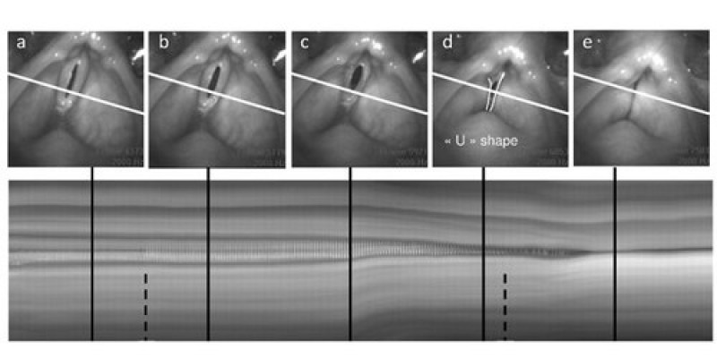 Dynamique des plis ventriculaires dans la phonation humaine